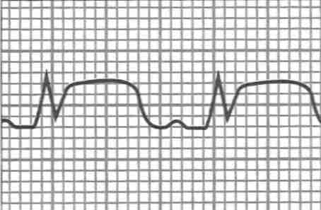 [ ST−segment elevation  ]
